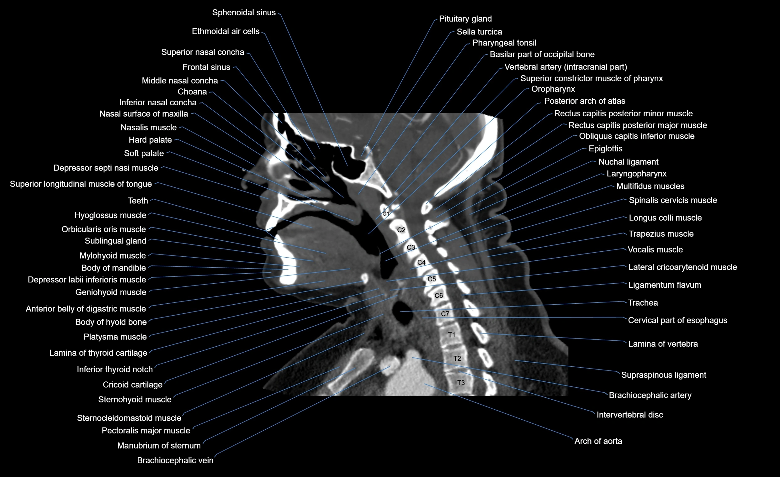 Neck CT sagittal cross sectional anatomy 3D  radiology  image-img-00001-00004.webp